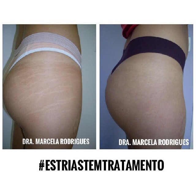 Tratamento para estrias em vitória es